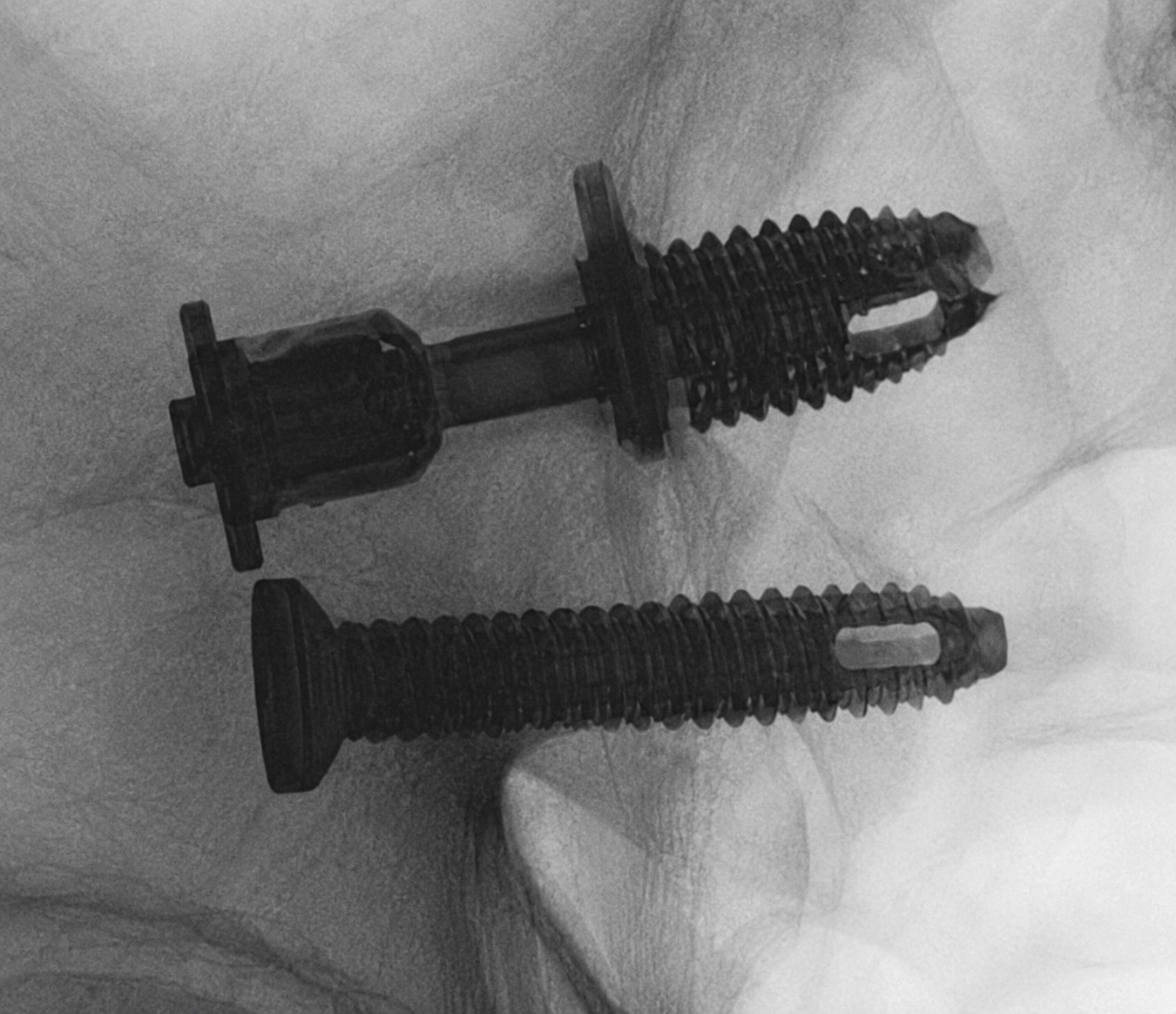 Secondary Stabilization — Radiograph