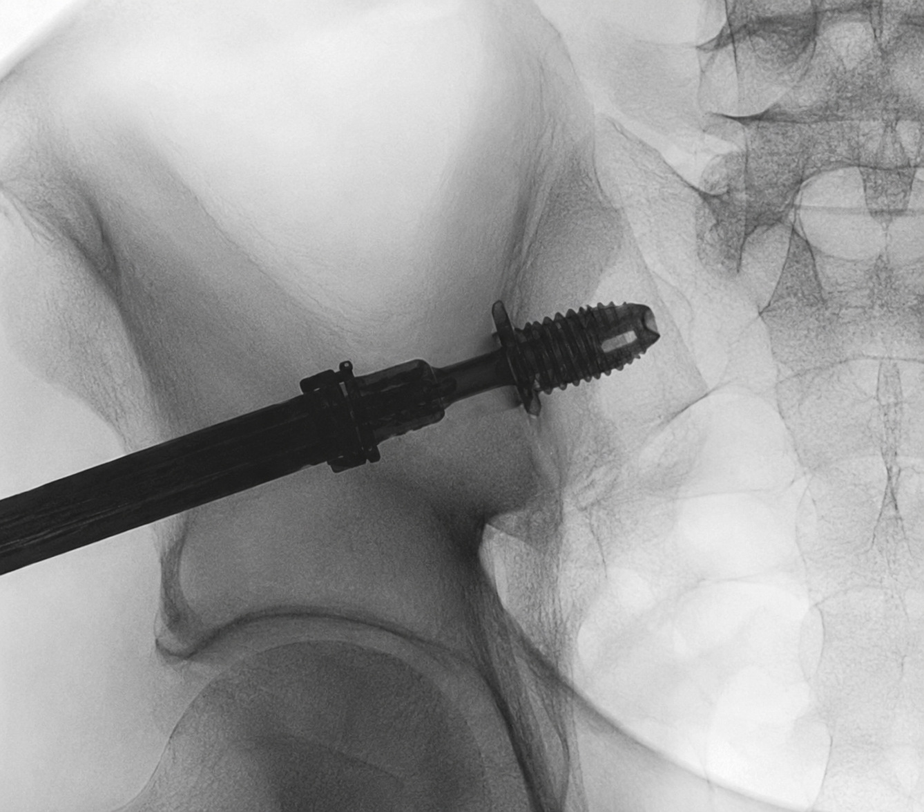 Compression — Intraoperative Radiograph