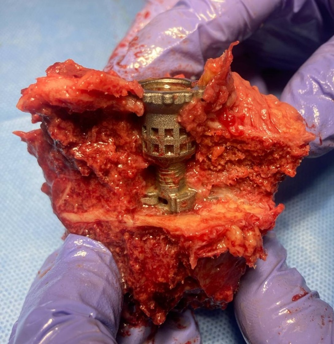 Cadaveric Implant Placement